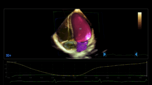 Kardio-Sonographie Herz-Ultraschall Philips
